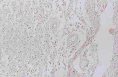 Figure 8. Old infract area of vassal ganglia from an individual (autopsy no. 0544). Macrophages were stained intensively by anti CB (8-A), moderately by anti-PGDS (8-B) and CC (8-C), and weakly by anti-PSA (8-D)