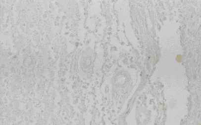 Figure 8. Old infract area of vassal ganglia from an individual (autopsy no. 0544). Macrophages were stained intensively by anti CB (8-A), moderately by anti-PGDS (8-B) and CC (8-C), and weakly by anti-PSA (8-D)