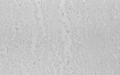 Figure 8. Old infract area of vassal ganglia from an individual (autopsy no. 0544). Macrophages were stained intensively by anti CB (8-A), moderately by anti-PGDS (8-B) and CC (8-C), and weakly by anti-PSA (8-D)