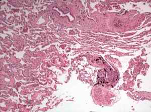 Fig. 1. A classic, small coal macule.  Black, coal-laden macrophages are contained within a delicate fibrous stroma. There is surrounding emphysema, consistent with the history of smoking