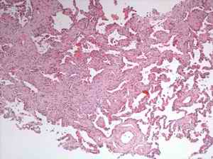 Fig. 3. A more severely involved area, in which nodularity can still be appreciated, and the loose fibrosis extends along the alveolar septa