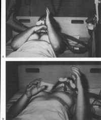 Arm elevation with neck flexion (A) and spontaneously (B)