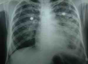 Figure 5 - Recovery of pulmonary edema by oral prazosin - At four hours