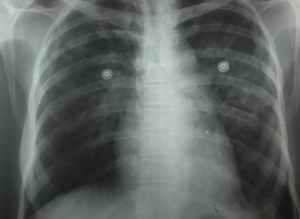 Figure 6 - Recovery of pulmonary edema by oral prazosin - At 24 hours.