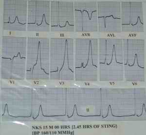 Figure 7 - Condition of arrival of a patient bitten by scorpion. Marked tented T waves in a case of scorpion sting with raised blood pressure
