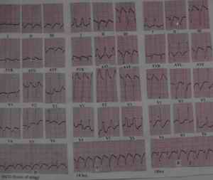 Figure 8 - Acute myocardial injury to the conducting system resulted in development of left anterior hemiblock and left bundle branch block