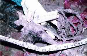 Picture 3: Depicting frank ecchymosis in the available neck tissues.