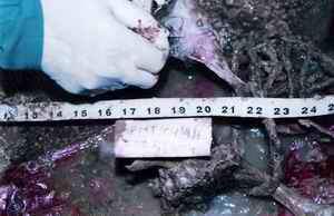 Picture 4a and 4b: Showing ecchymosis in laryngeal structures visualized even after 6 months in a gutter in this skeletonized body.