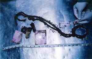 Picture 5a and 5b: Showing ecchymosis in laryngeal structures visualized even after 6 months in a gutter in this skeletonized body.