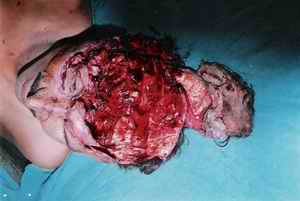 Picture 1a and 1b: Pictures showing exploded calvarium with multiple fragments of skull bones attached with scalp on the back of the head. Both cerebral hemispheres were missing
