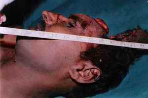 Picture 2a and 2b: Pictures depicting the lower arc of a firearm entry hole (punched in) on the left temporal region without effects of powder blast and with extruded calvarium
