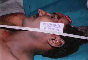 Picture 2a and 2b: Pictures depicting the lower arc of a firearm entry hole (punched in) on the left temporal region without effects of powder blast and with extruded calvarium