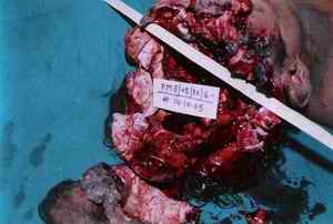 Picture 3: Showing beveled punched out margin of the entry hole (inner table of left temporal bone).
