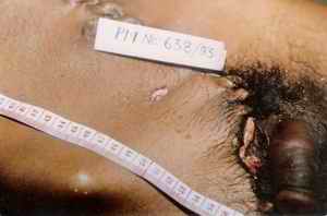 Picture 1: Picture showing firearm entry wound with abraded collar, more so marked on left side of wound situated on the right front lower middle aspect of abdomen.
