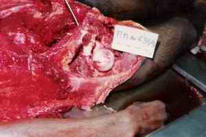 Picture 2a and 2b: Probe in the acetabulum indicating track of bullet, found impacted in the head of femur, when rotated laterally after opening the right hip joint in situ.