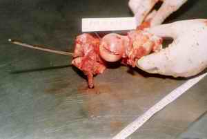 Picture 3a, 3b and 3c: The acetabulum and upper part of femur were removed after dissection. The track was reconstructed