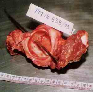 Picture 3a, 3b and 3c: The acetabulum and upper part of femur were removed after dissection. The track was reconstructed