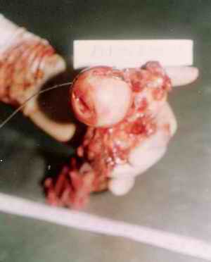 Picture 3a, 3b and 3c: The acetabulum and upper part of femur were removed after dissection. The track was reconstructed