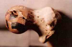 Picture 4a to 4e: The upper part of femur with head was cleaned and the bullet was removed and placed on the side from where it was found impacted.