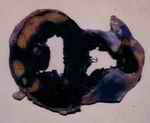 Figure 6. Infarct areas of anterior and lateral walls of left ventricle. Note  unstained areas, which represent infarcts