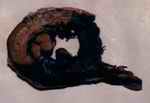 Figure 8. Transmural infarct of anterior and lateral walls of left ventricle, with involvement of papillary muscles