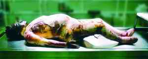 Picture 2: Mother's Body at Autopsy - The face is swollen by putrefied gas and the color of the skin is a yellowish green, and large putrid blisters are visible on the skin. No maggots are on her skin, although there were many maggots on his skin