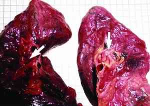 Picture 3.Pulmonary embolism - A large saddle embolus with fibrin tissue and a hard brownish hard clot were detected at the bifurcation of the main pulmonary trunk