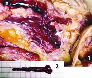 Picture 4: Thrombi - A stick-shaped dark brown hrombi (5cm in length, 0.5cm in width) with dark brown color was found inside of the right iliac vein (Photo 4-1), and the removed thrombi (4-2)