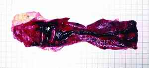 Picture 3.Pulmonary embolism - A large saddle embolus with fibrin tissue and a hard brownish hard clot were detected at the bifurcation of the main pulmonary trunk