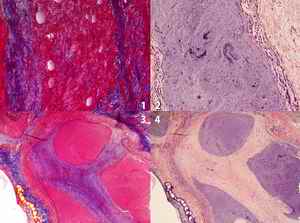 Picture 6. Histological examination of the lungs from the woman - The histological examination of the lungs from the woman using both the Azan-Mallory (AM) stain and PTAH stain could revealed the existence of purplish fibrin strands with purplish color in the small size arteries (6-1 with AM stain and 6-2with PTAH stain) and of the substantial re-canalization of older thrombi in a medium-sized pulmonary artery (6-3 with AM stain and 6-4 with PTHA stain)