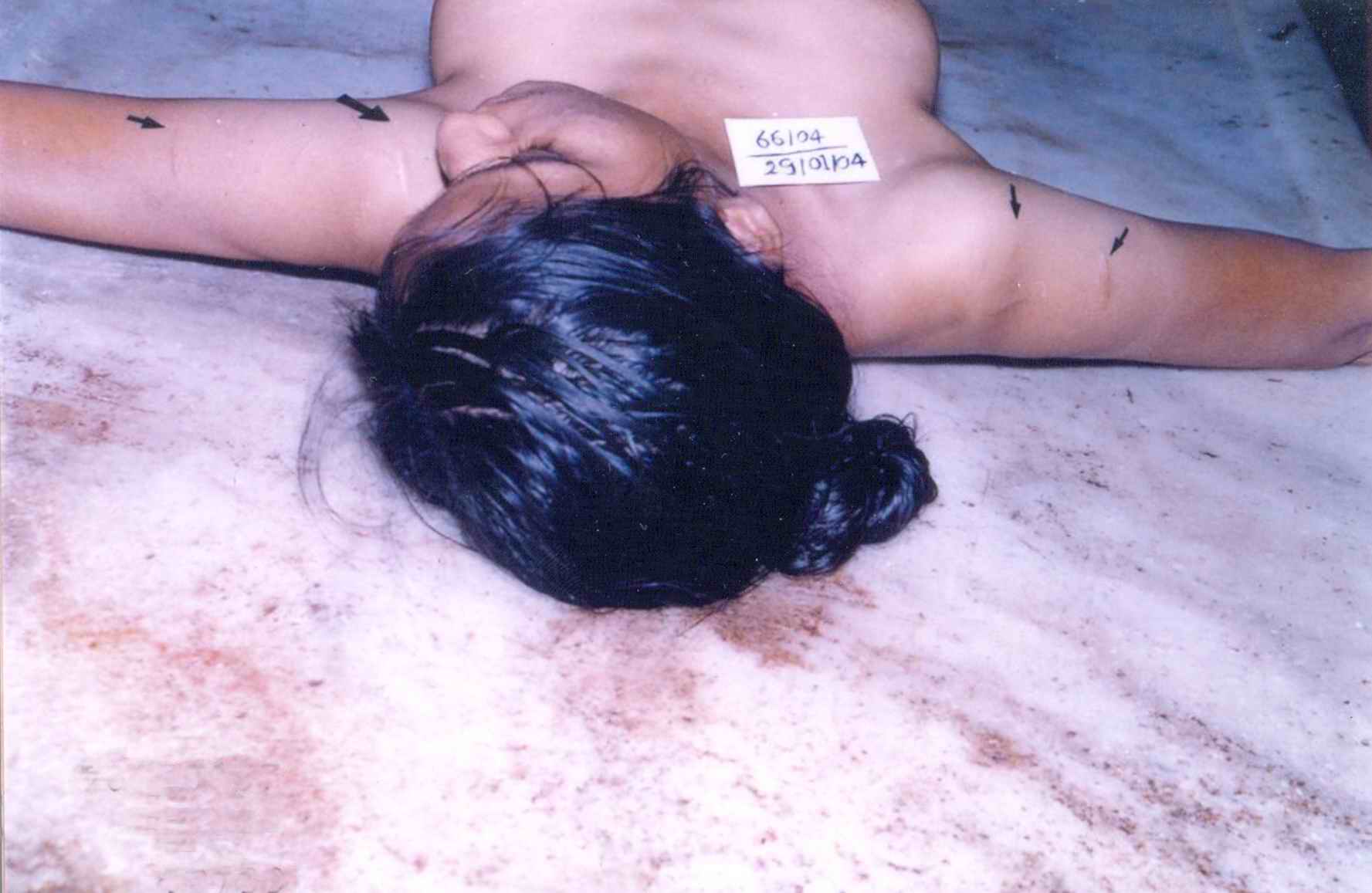 poster 1 - Multiple scars of varying age- Self inflicted healed injuries in a psychiatric person