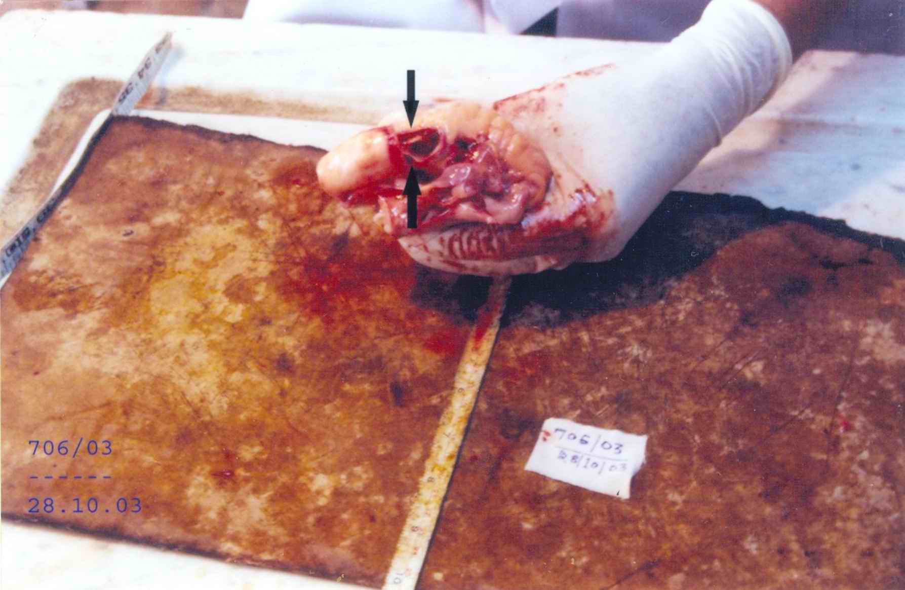 poster 2 - Traumatic transection of aorta and also attempted erasure of tattoo marks