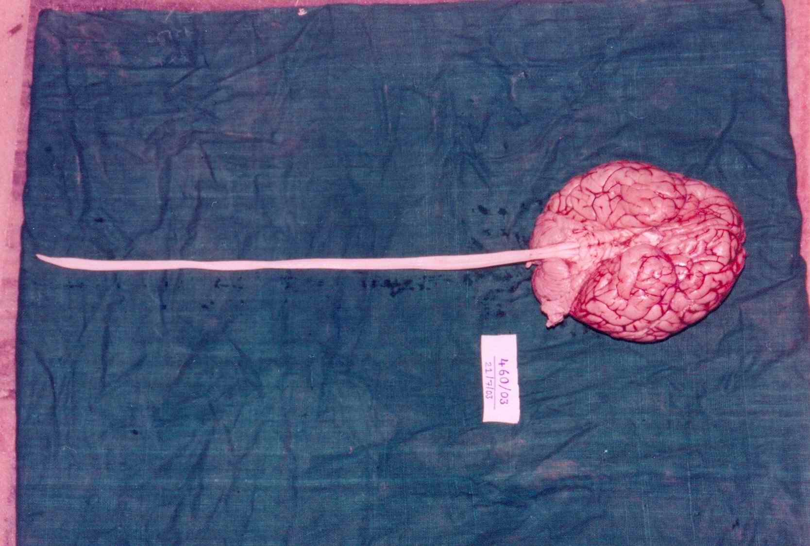 poster 3 - Spinal cord comes along the removal of brain. Postmortem artifact: Any taker?