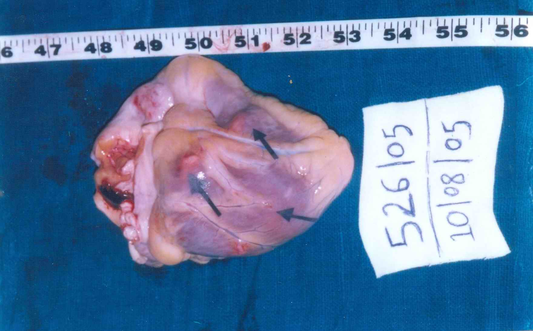 poster 4 - Metastasis in heart from a primary carcinoma of hypopharynx -A rare event.