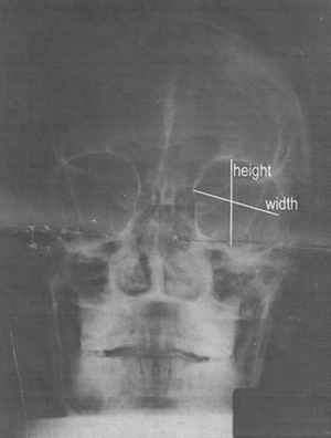 Figure 1. A typical X-ray used in this study. Please note how height and width were taken from X-rays