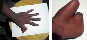 Figure 1. Incomplete Radial Polysyndactyly showing distortion and ridge pattern on supernumerary and main finger