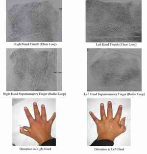 Figure 2. Radial Polydactyly showing distortion in both hands and inked fingerprints of supernumerary and main finger