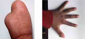 Figure-3: Complete Complex Radial Polysyndactyly showing distortion in hands and ridge patters on fused fingers