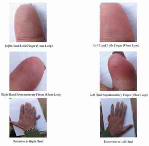 Figure-4: Ulnar Polydactyly showing distortion in both hands and ridge pattern on supernumerary and main fingers