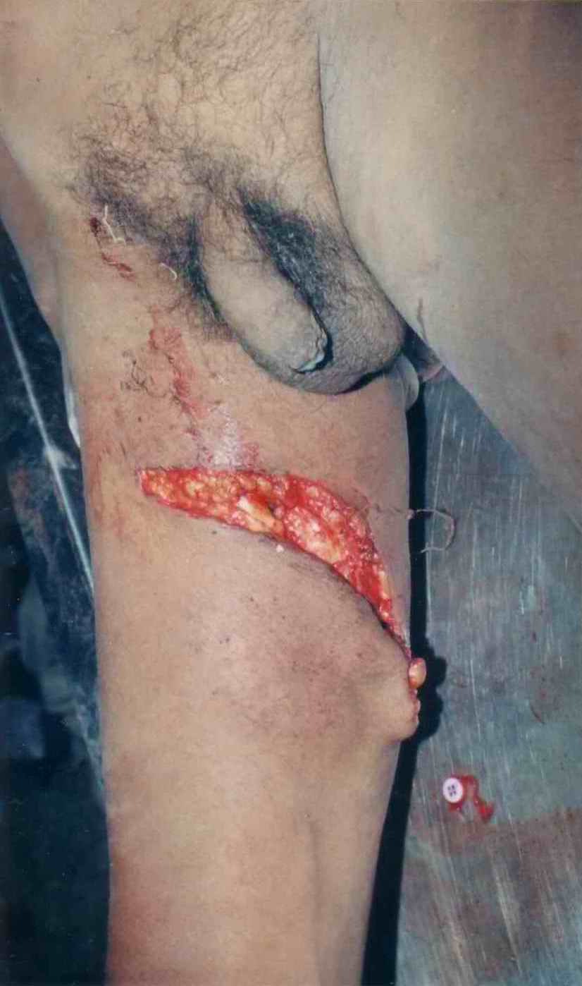 Figure 2. Lacerated wound over thigh in case 1