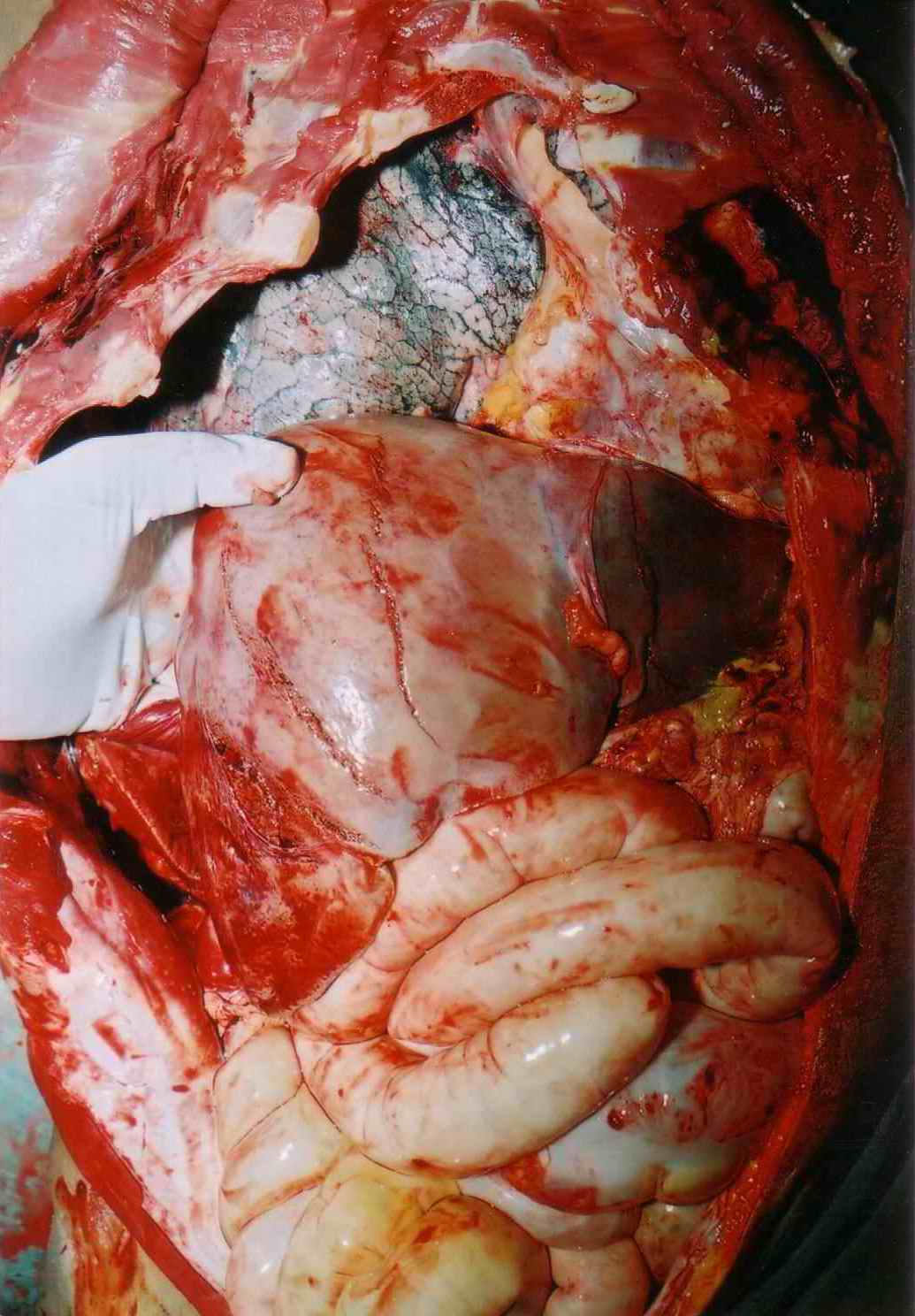 Figure 3. Rib fractures and lacerations of liver in case 2