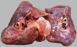 Figure 2. Relatively newly developed thrombi with small amounts of fibrin observed on both pulmonary arteries
