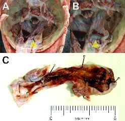 Figure 3. A brownish-green colored thrombus (arrow heads in A and B) detected in the right-transverse sinus. I am deeply sorry that these pictures are out of focus. After fixing with formalin, the organized thrombus was observed in the transverse sinus (C). [Click all pictures to enlarge]