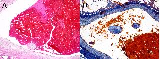 Figure 4. New thrombi detected on the middle size pulmonary arteries of both lungs. The thrombi consisted of an erythrocyte clot and tissue segments, which contained elastic fiber similar to those in endothelial wall of pulmonary artery and hemosiderin pigments similar to those in thrombus in the transverse sinus. The tissue segment slightly adhered to arterial walls only on several sections of the adjacent 40 tissue sections. (A: HE stain, and B: Azan-Mallory stain)
