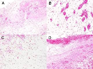 Figure 6. Histological staining revealed that thrombus in the transverse sinus was consisting of organized tissue (A) containing many capillaries (B), a lot of hemosiderin pigments(C) and fibrinous tissue with bleeding (D). Many capillaries showed   producing the recanalisation in the organized tissue. [Click all pictures to enlarge]
