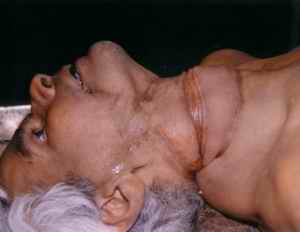 Figure 2. Ligature Mark around the face and neck