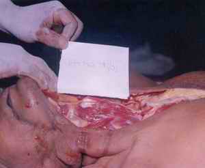 Figure 3. There was no effusion of blood in soft tissues and neck muscles