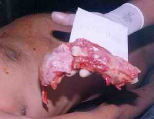 Figure 4. Internal structures of neck with no fractures of hyoid- thyroid complex