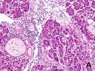 Figure 1.  HE stains in the pancreas, the thyroid gland and the tonsil. Numerous lymphocytes were stained around the lobes of the pancreatic exocrine cells (1-A), inter-spaces of colloidal cells of the thyroid gland (1-B) and around the tonsil by HE stain (1-C). The beta cells in the pancreatic islet were practically destroyed (1-D). The infiltration manner of lymphocytes in the thyroid gland is different from that of Hashimoto disease. [Click all pictures to enlarge]