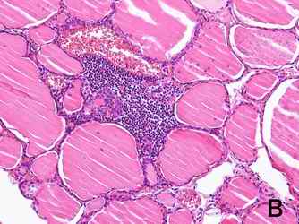 Figure 1.  HE stains in the pancreas, the thyroid gland and the tonsil. Numerous lymphocytes were stained around the lobes of the pancreatic exocrine cells (1-A), inter-spaces of colloidal cells of the thyroid gland (1-B) and around the tonsil by HE stain (1-C). The beta cells in the pancreatic islet were practically destroyed (1-D). The infiltration manner of lymphocytes in the thyroid gland is different from that of Hashimoto disease. [Click all pictures to enlarge]